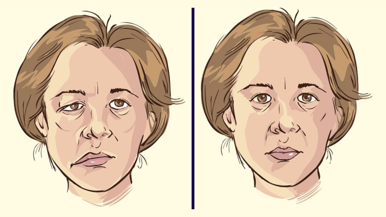 Tai biến mạch máu não để lại nhiều di chứng nặng nề