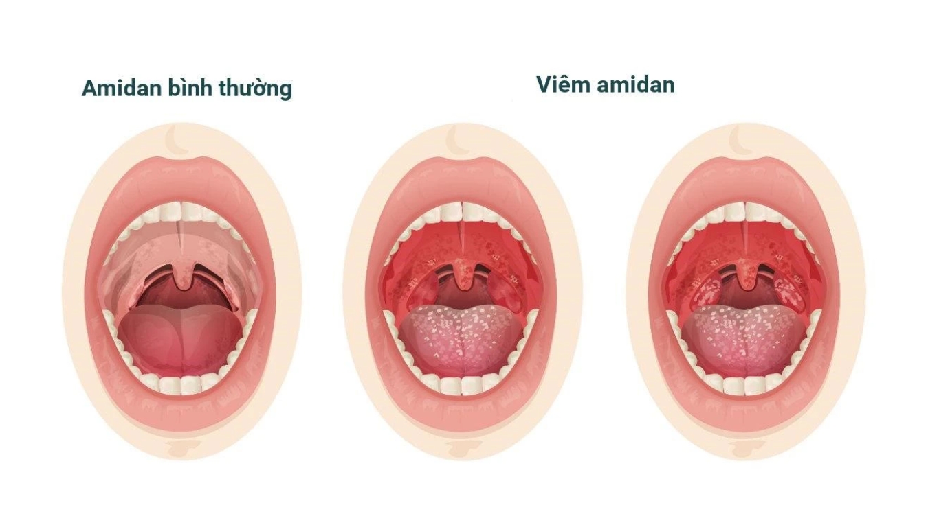 viêm amidan thường là tình trạng viêm tấy và sưng đỏ