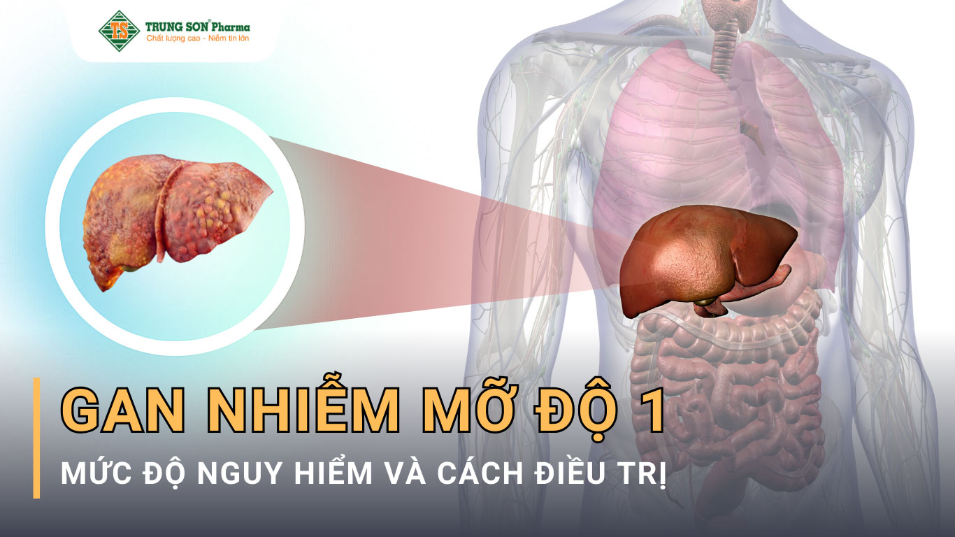 Gan nhiễm mỡ độ 1 là tình trạng có một lượng mỡ nhỏ tích tụ trong gan