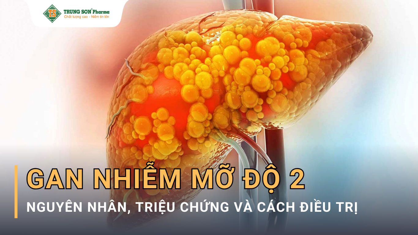 Gan nhiễm mỡ cấp độ 2