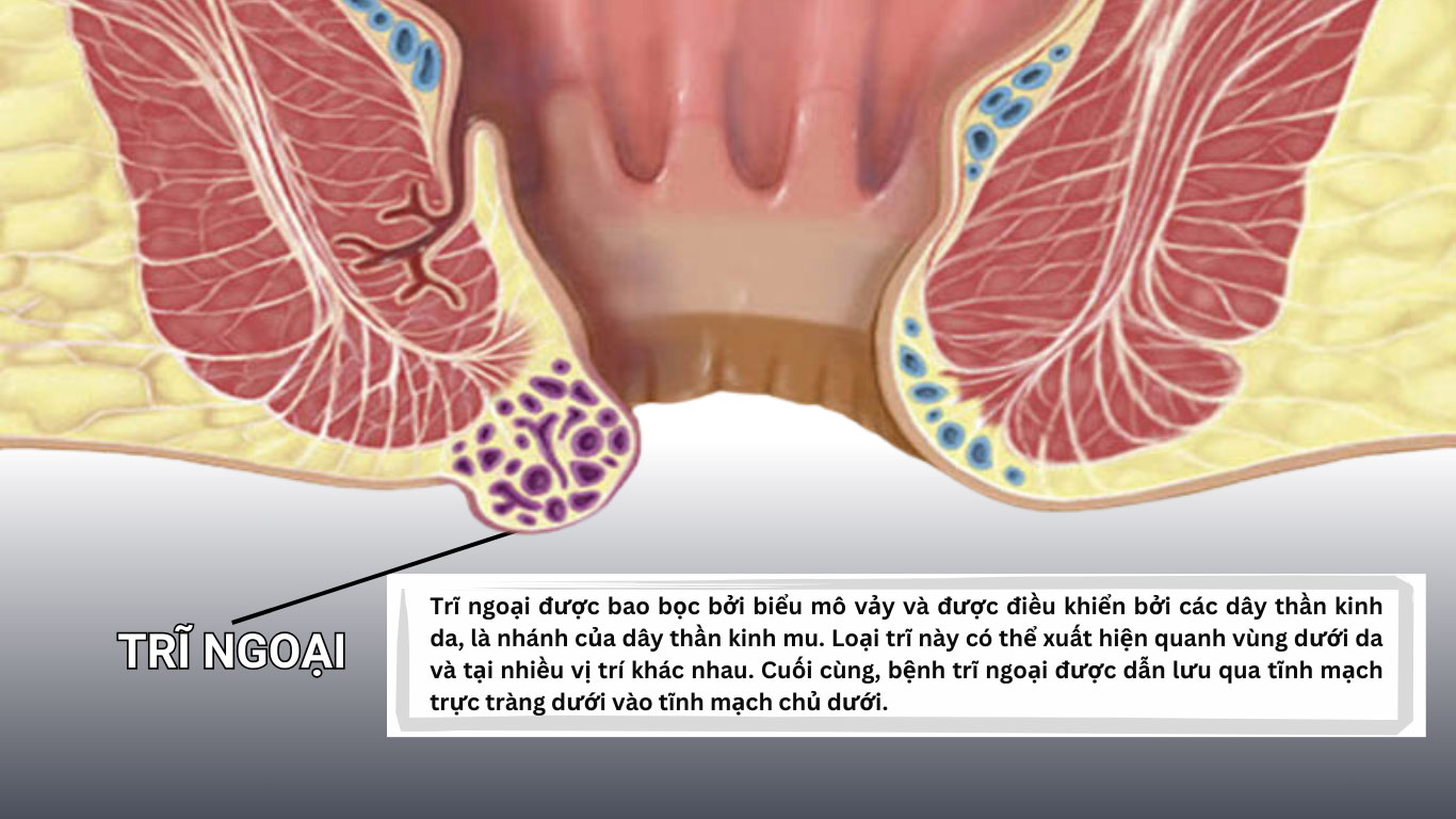 Bệnh trĩ ngoại có thể gây ra cơn đau kéo dài từ 5 đến 7 ngày