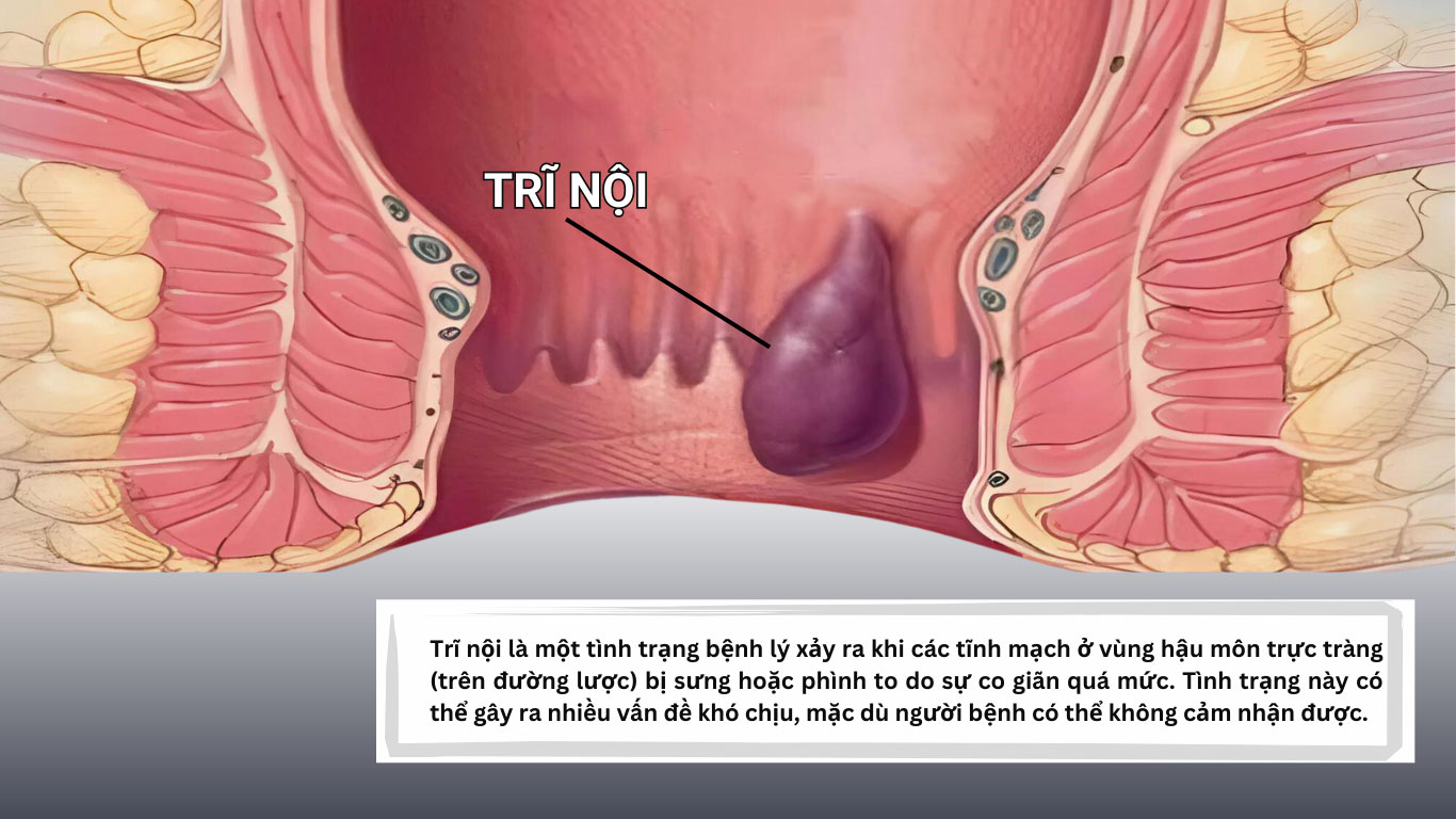 Bệnh trĩ nội thường phát triển gần cuối trực tràng và không thể nhìn thấy hoặc sờ thấy trừ khi nó sa ra ngoài