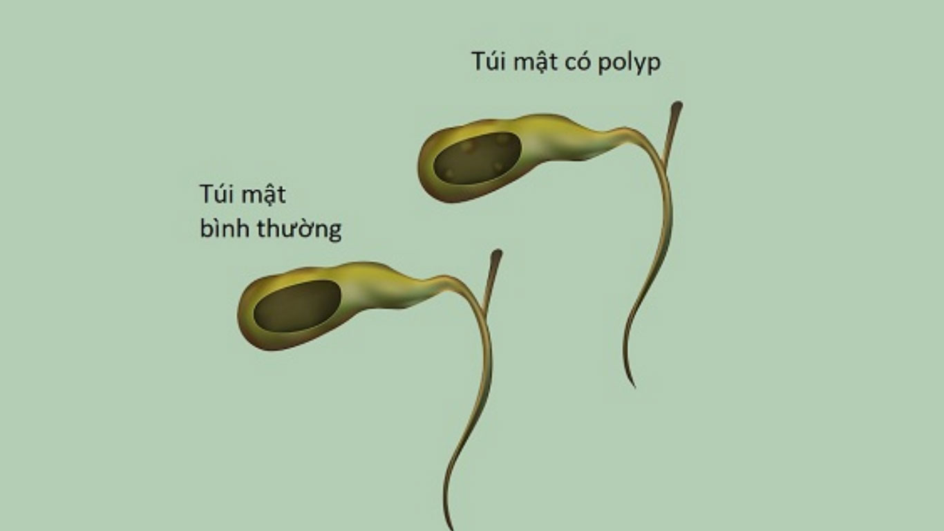 Túi mật bình thường và khi bị Polyp túi mật