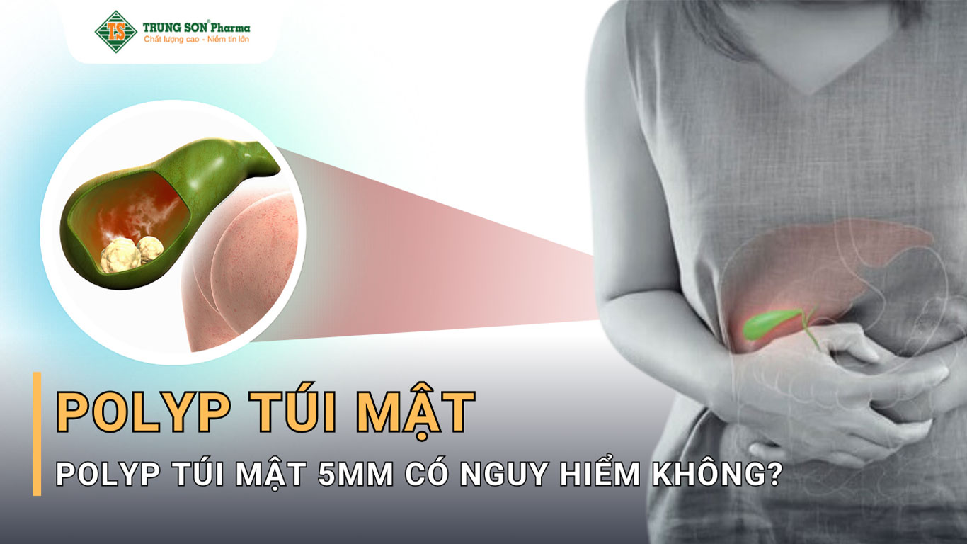 Polyp túi mật và mức độ nguy hiểm