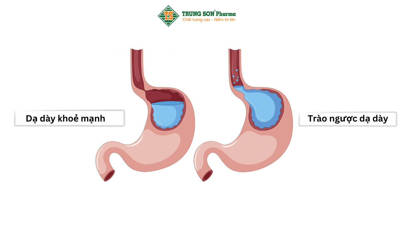 Trào ngược dạ dày xảy ra khi các cơ chế bảo vệ thực quản không còn hiệu quả trước sự trào ngược của chất từ dạ dày