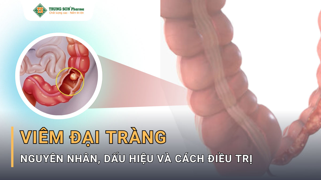 Bệnh viêm đại tràng gây ra tình trạng viêm và loét trong hệ tiêu hoá