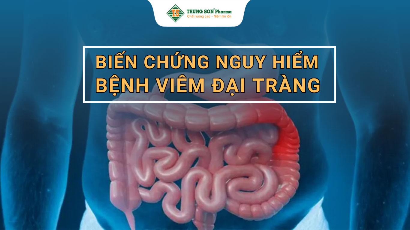 Viêm đại tràng gây ra các biến chứng nguy hiểm