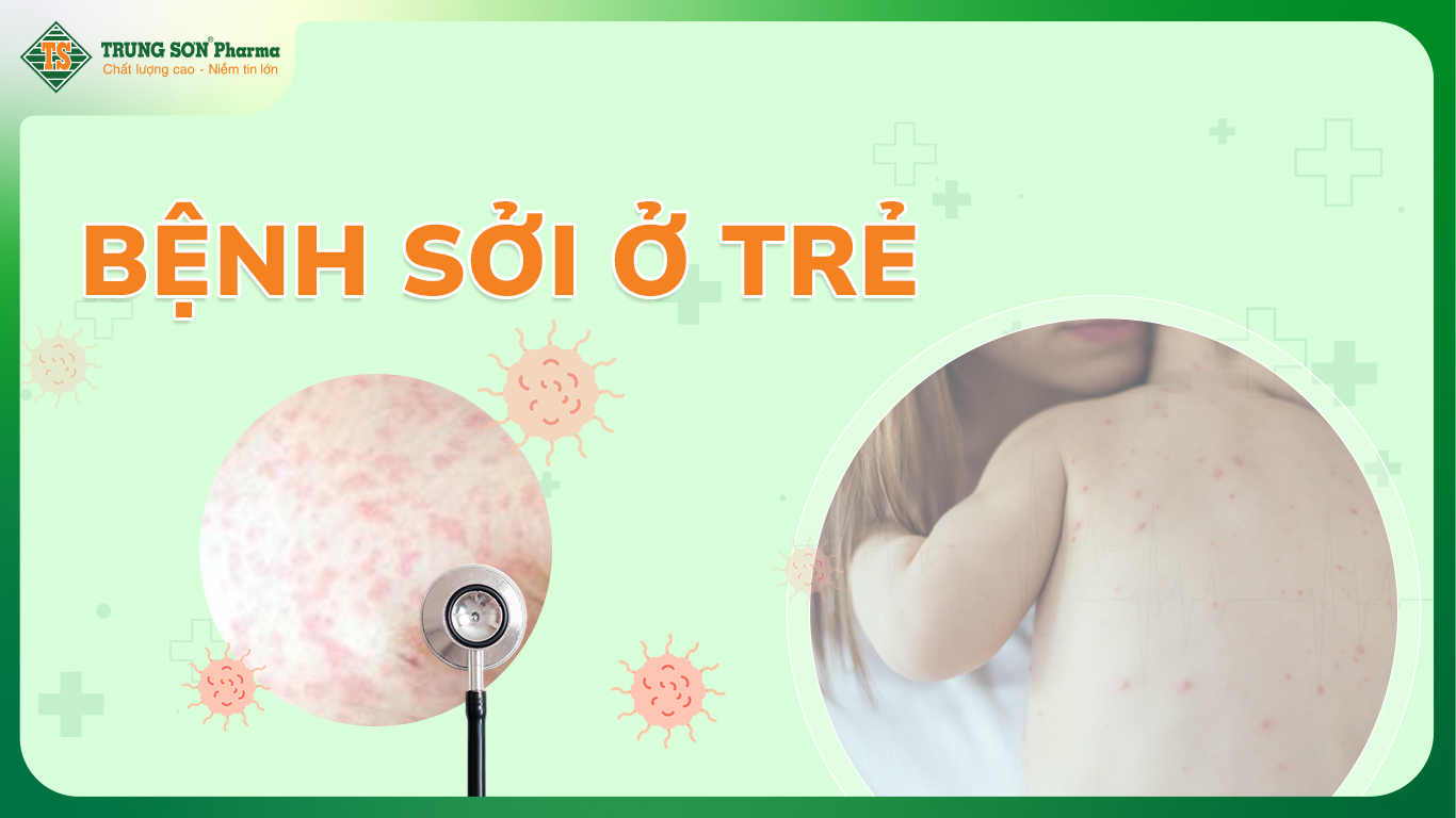 Bệnh sởi hay còn được gọi bệnh rubeola -  là một bệnh nhiễm trùng ở trẻ em