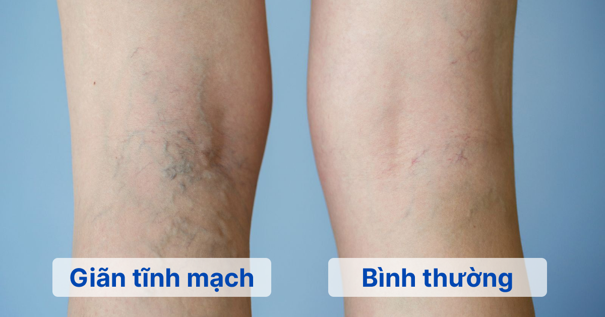Chân bị giãn tĩnh mạch và chân bình thường