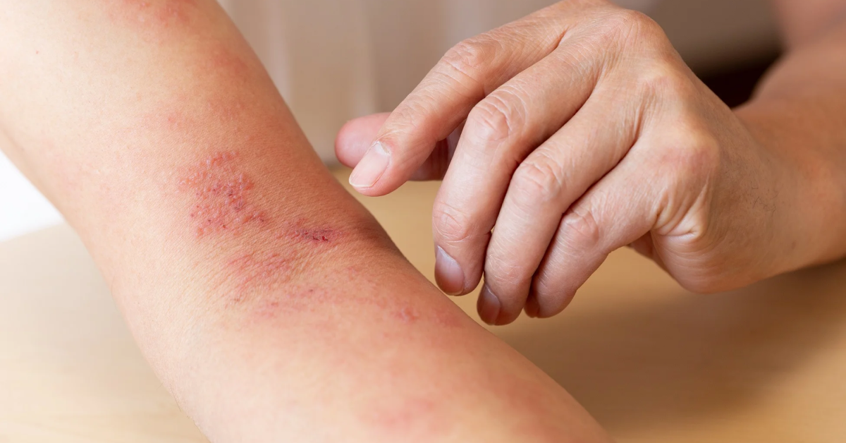 Zona thần kinh (còn gọi là giời leo)