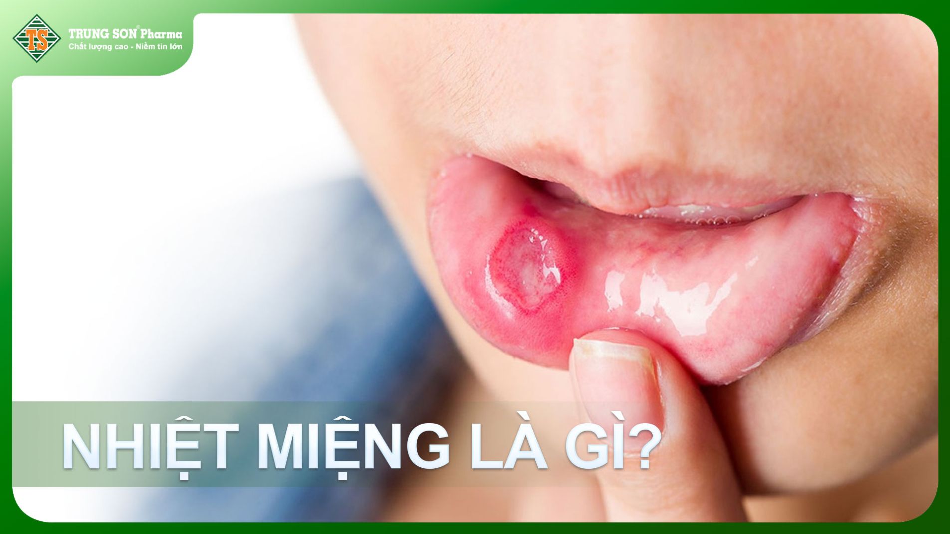 Hình ảnh minh họa vết nhiệt miệng điển hình.