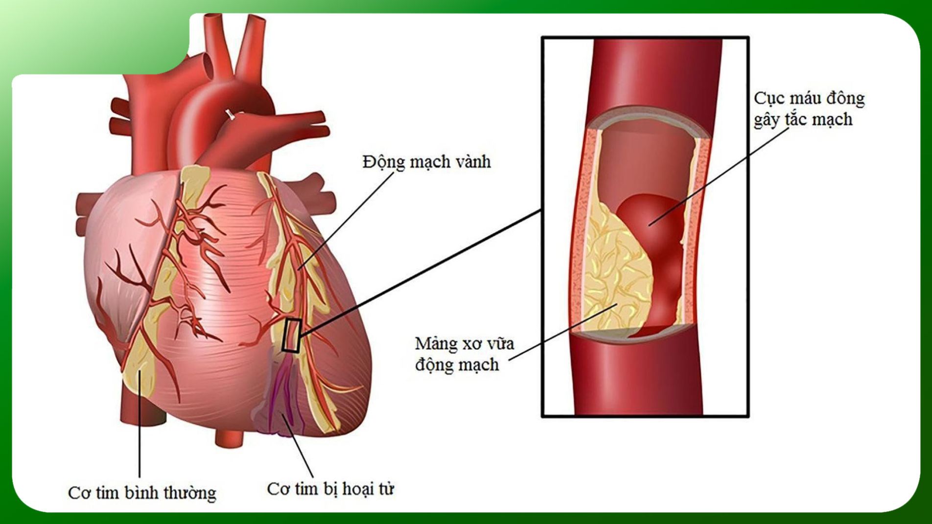 Nhồi máu cơ tim: Biến chứng tim mạch nguy hiểm của đái tháo đường