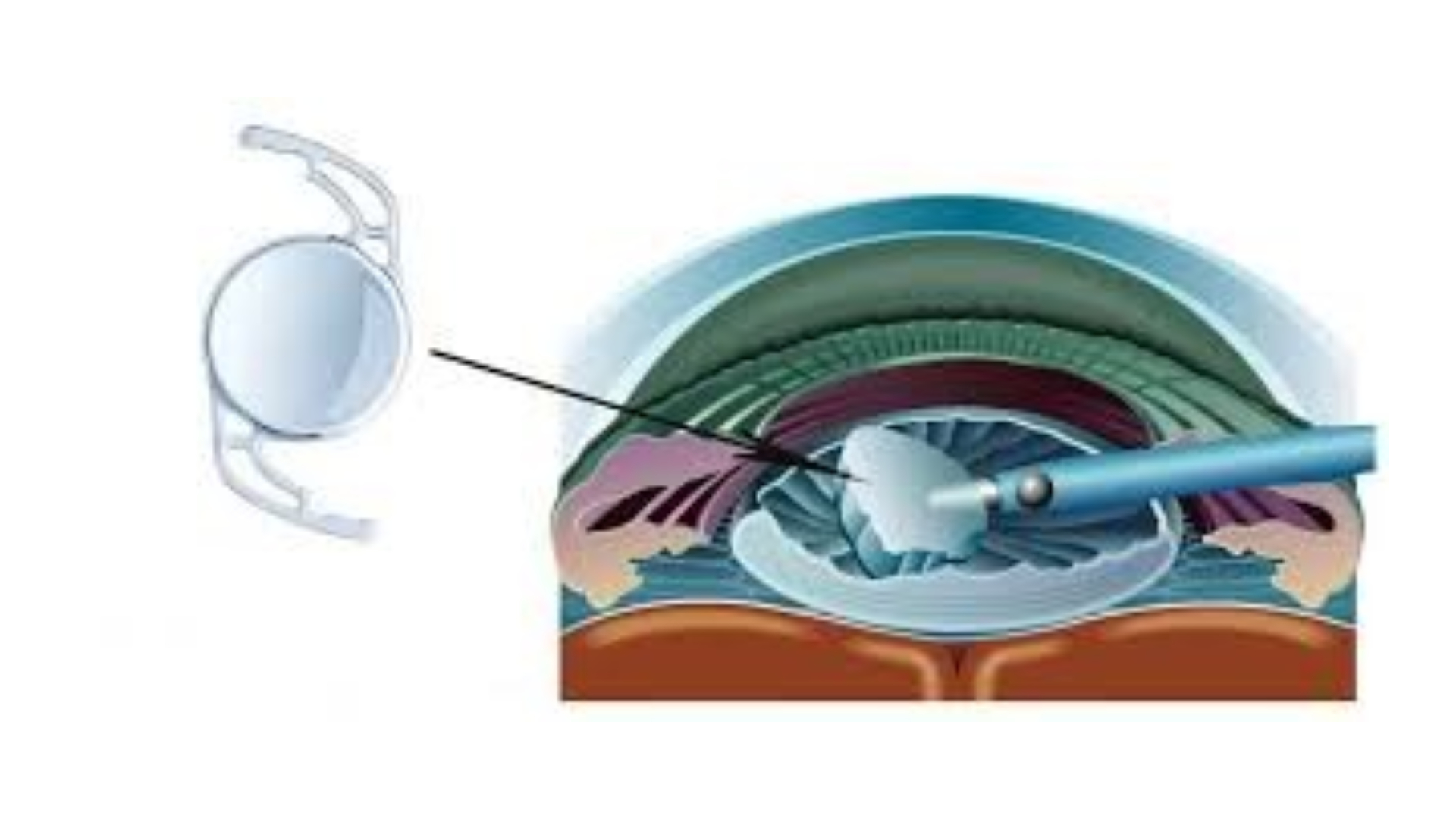 Quá trình phẫu thuật thay thủy tinh thể nhân tạo (tueanh-vn) 3