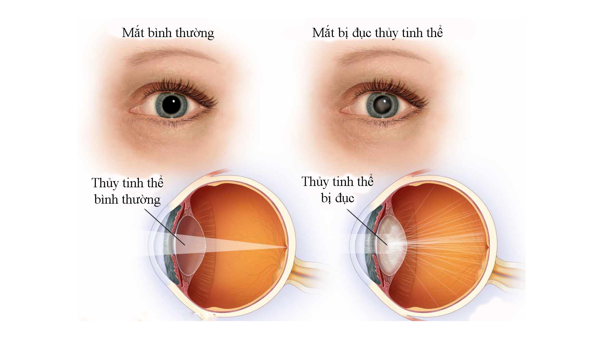 So sánh mắt bình thường và mắt bị đục thủy tinh thể- (matansinh-com) 1