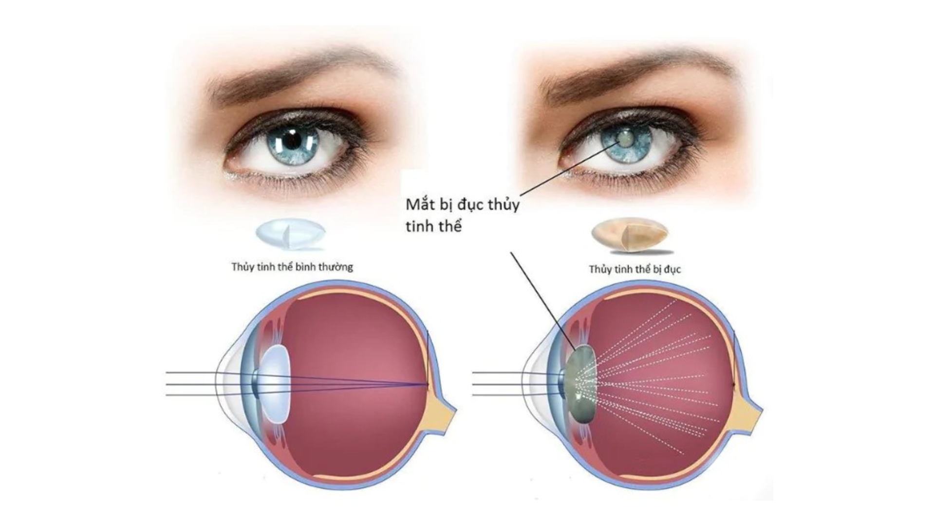 Triệu chứng mờ mắt do đục thủy tinh thể- (bvdkgiadinh-com) 2