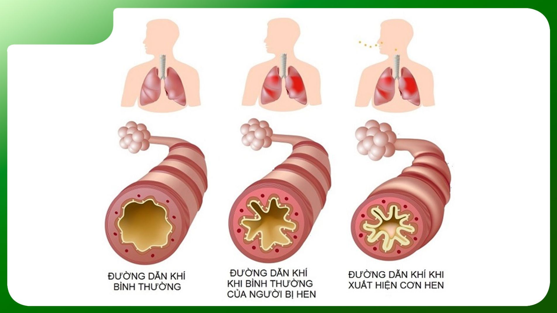Sơ đồ đường hô hấp bình thường và khi bị hen phế quản co thắt. "so sánh phế quản bình thường và hen phế quản co thắt"