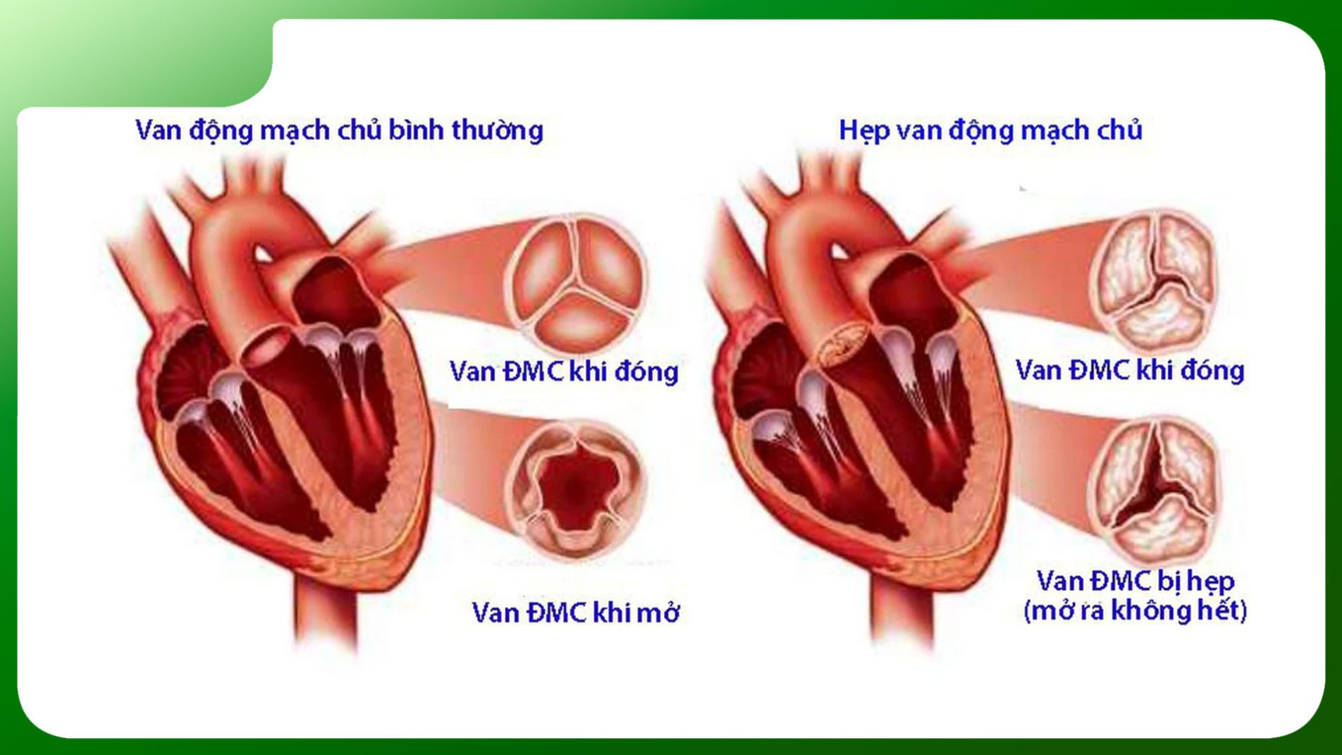 Bệnh hở van tim: triệu chứng sớm nhất và cách điều trị