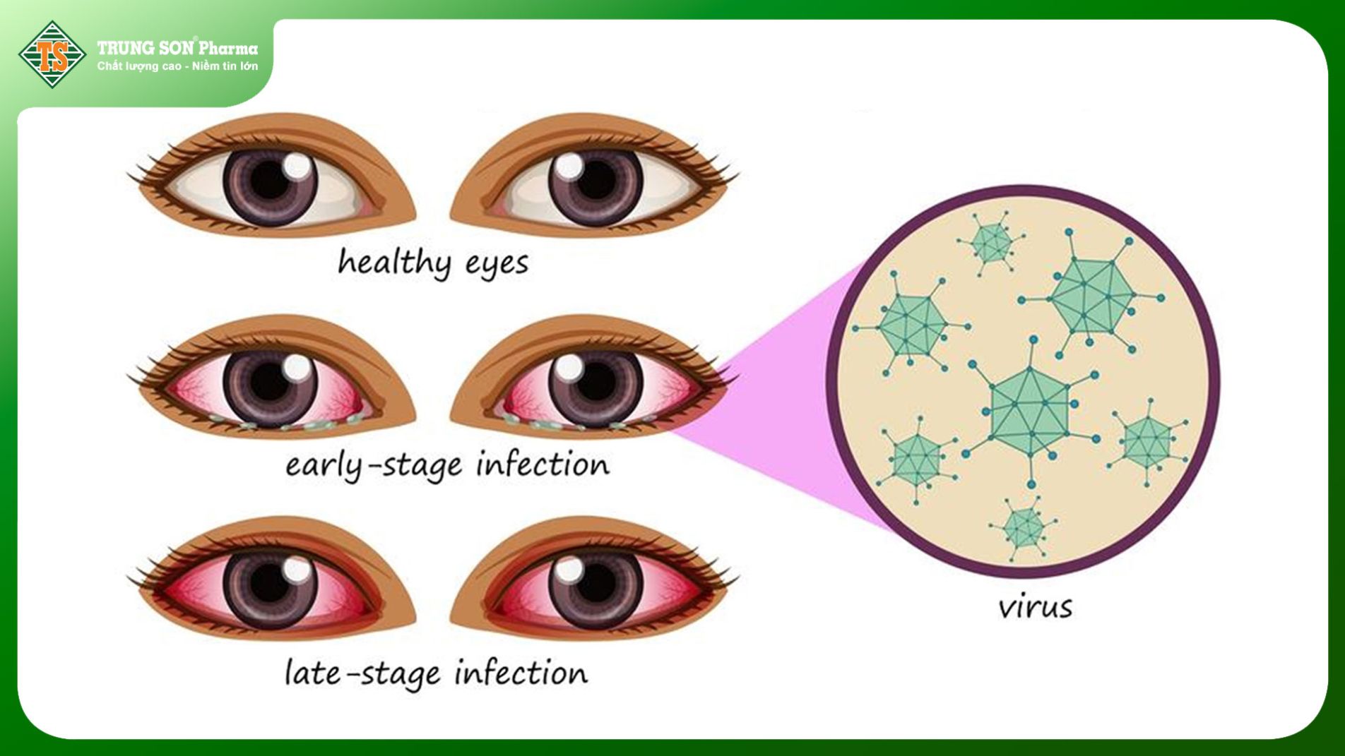 Hình minh họa về triệu chứng mắt đỏ do viêm kết mạc virus (pink eye). drparthshah.com.au