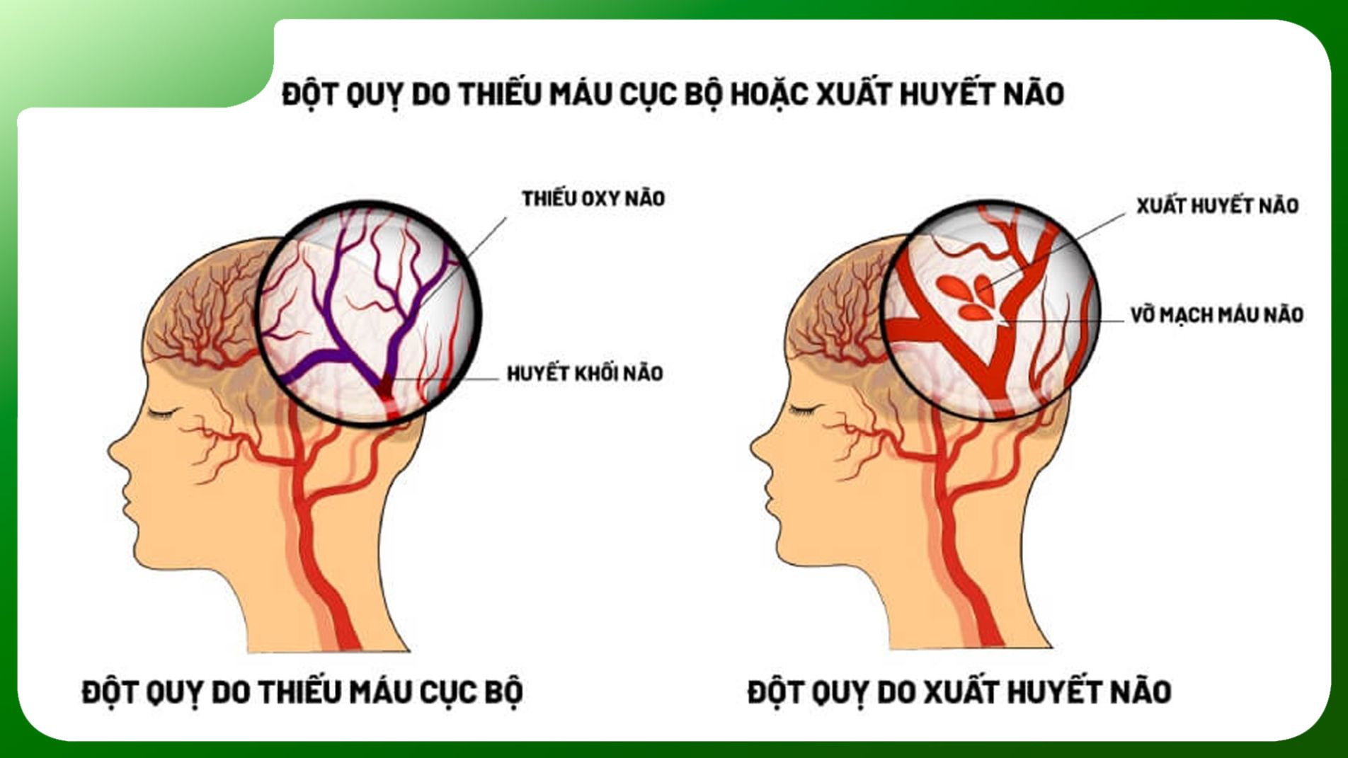 “Hai dạng tai biến mạch máu não phổ biến nhất”