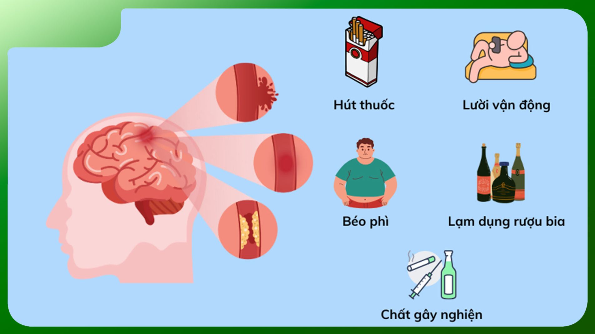 Biểu đồ 7 nguyên nhân chính gây tai biến mạch máu não. Nguồn: Tổng cục Thống kê Y tế 2024”).