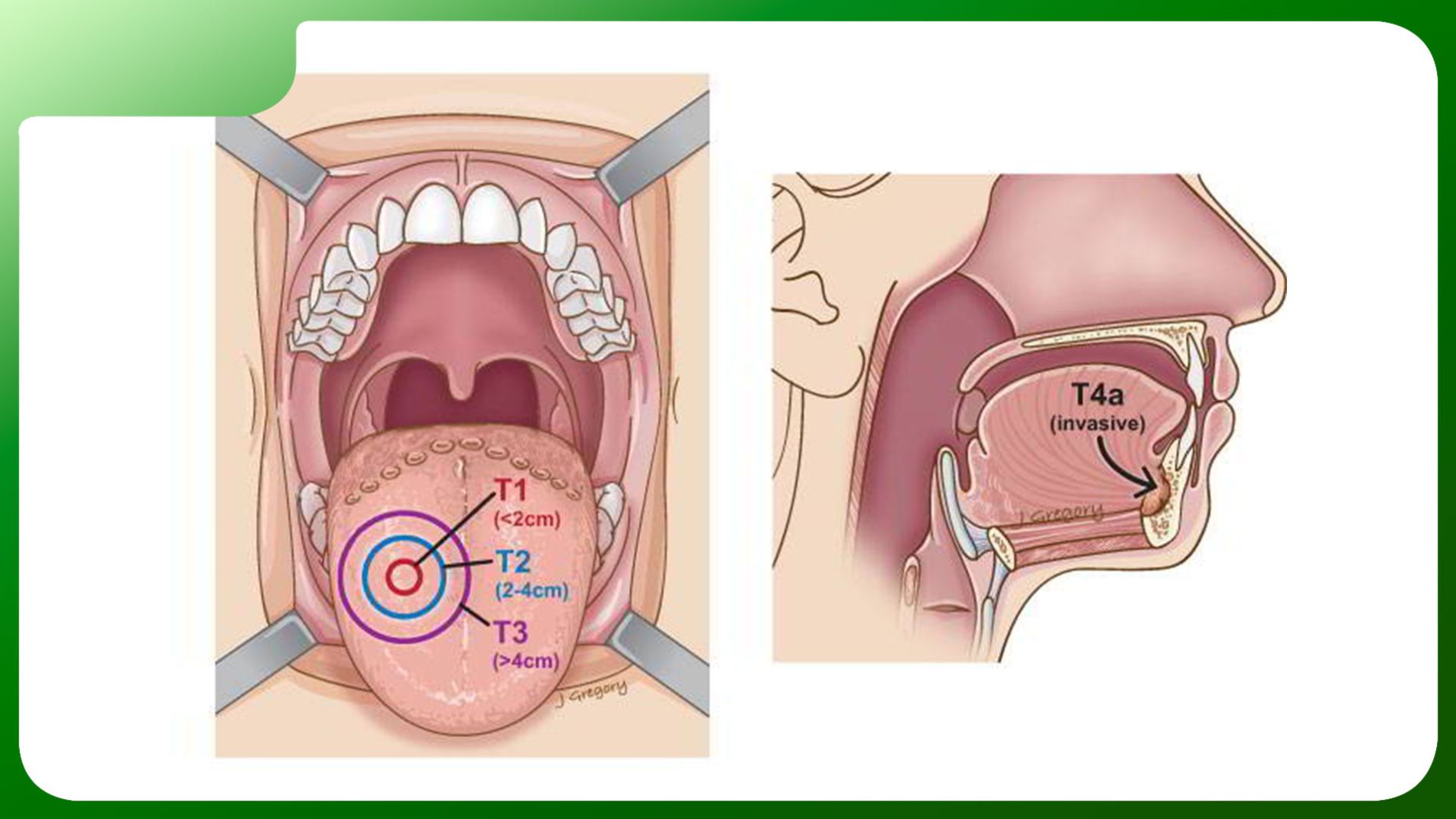 Hình minh họa cấu trúc lưỡi và các giai đoạn ung thư lưỡi.