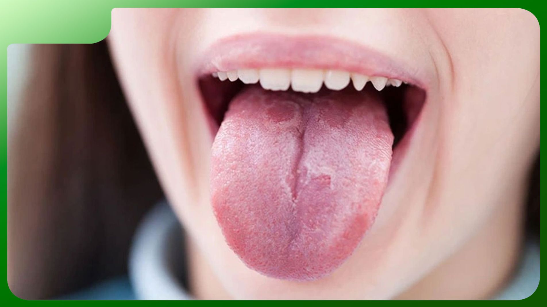 Hình ảnh minh họa dấu hiệu triệu chứng ung thư lưỡi trên bề mặt lưỡi. 