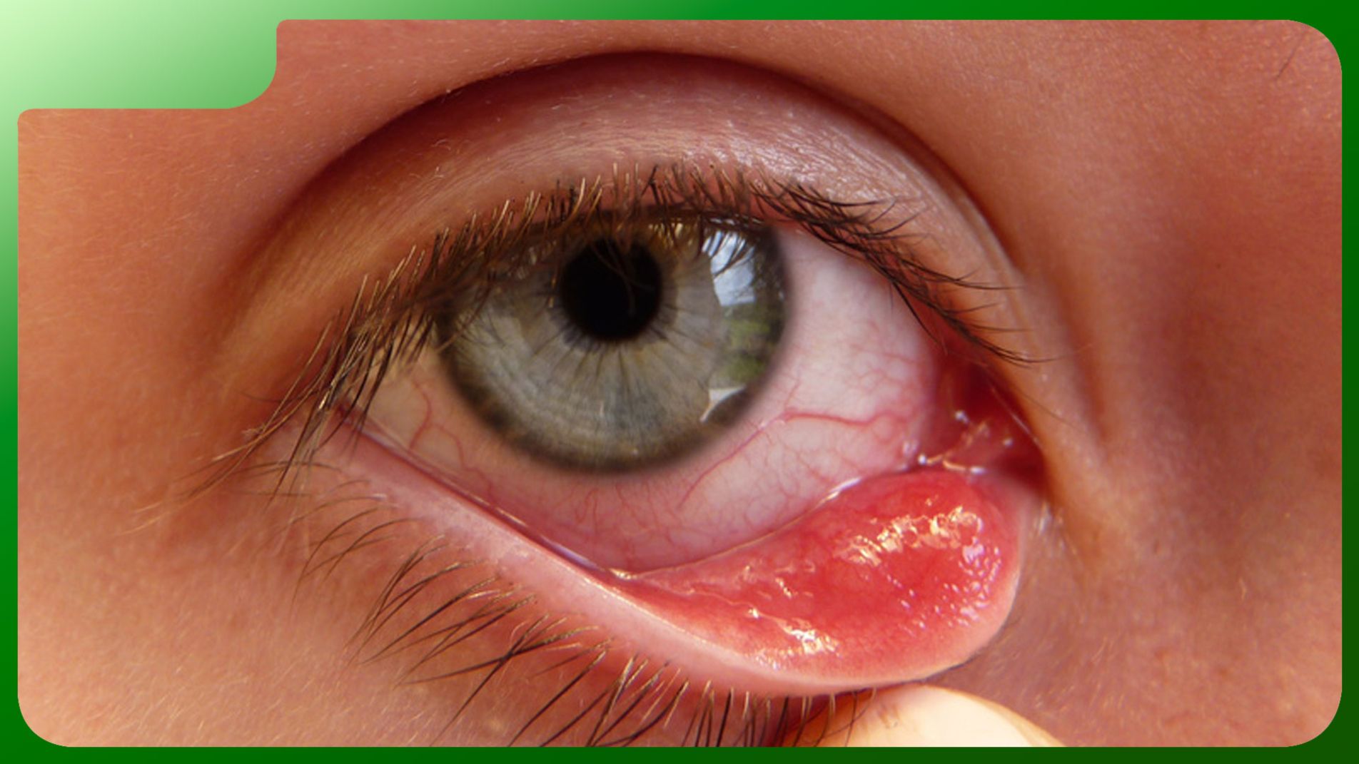 Viêm giác mạc nhiễm trùng. 