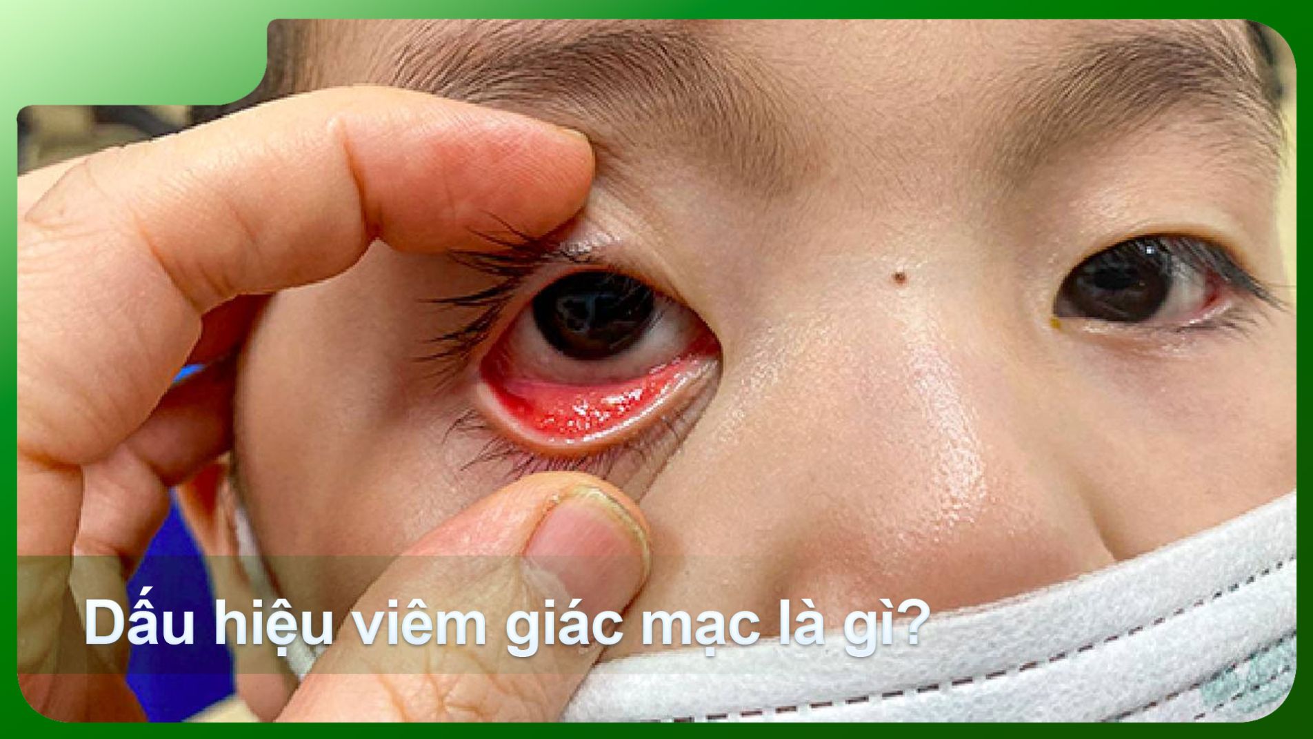 Minh họa triệu chứng mắt đỏ và khó chịu do viêm giác mạc