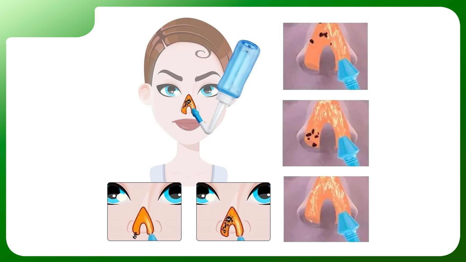 Cách rửa mũi bằng nước muối sinh lý để điều trị viêm mũi tại nhà.