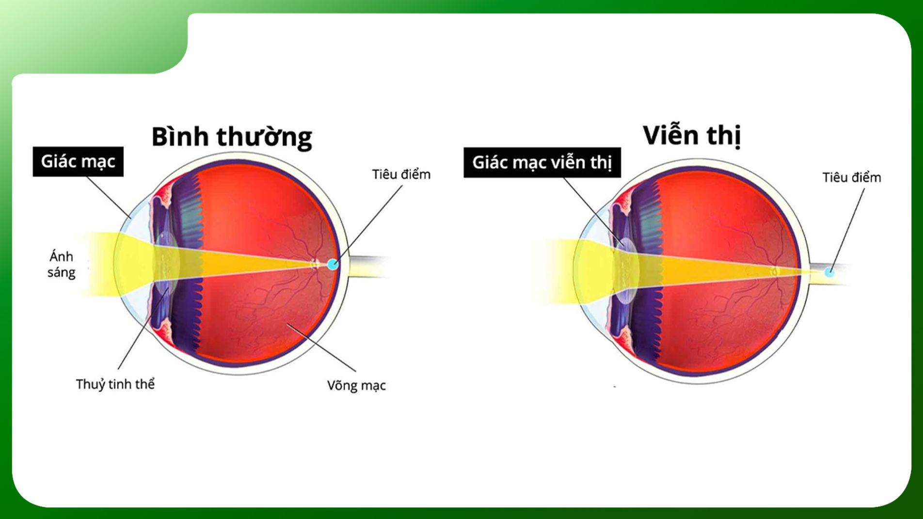 Hình ảnh minh họa cấu trúc mắt bình thường và mắt viễn thị, cho thấy sự khác biệt trong cách ánh sáng hội tụ (kinhmatbichngoc.vn)