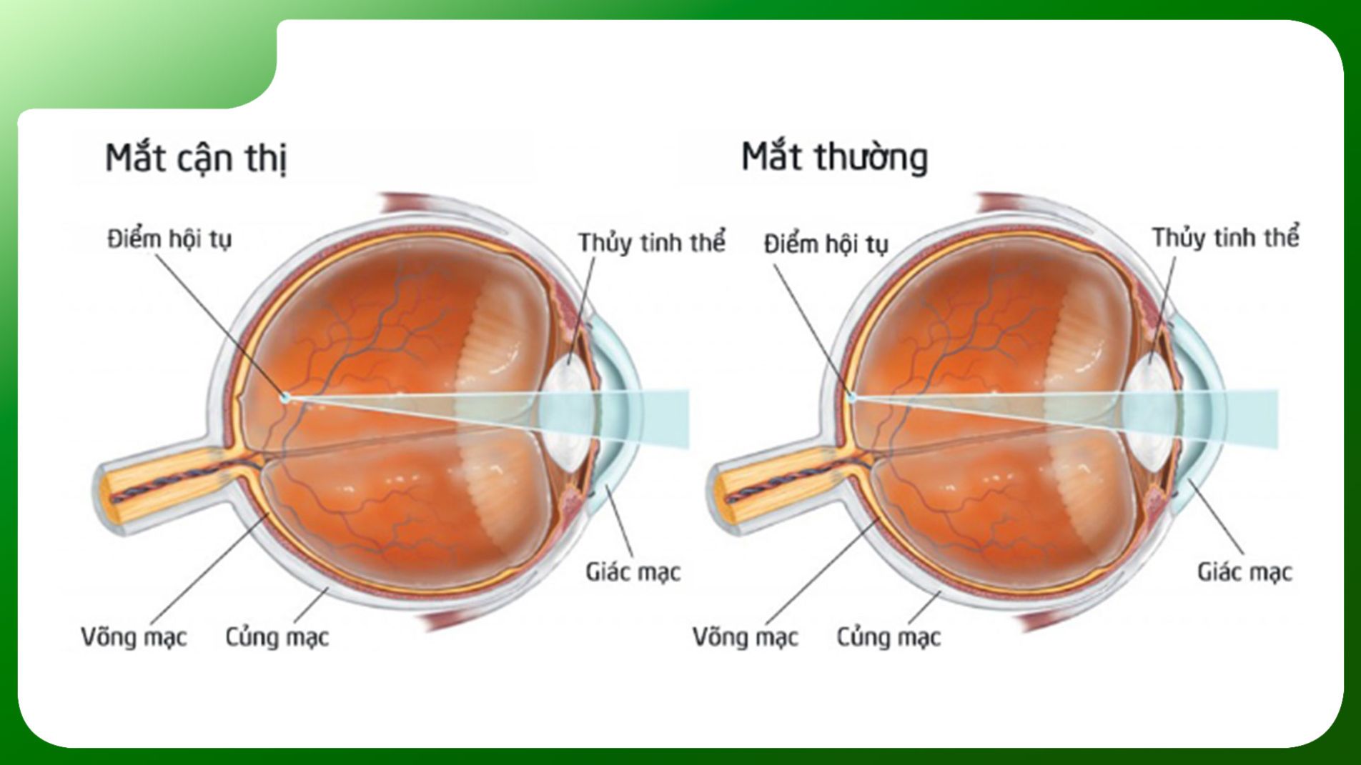 Minh họa viễn thị qua cấu trúc mắt, với tiêu điểm rơi sau võng mạc. (matsaigon.com)