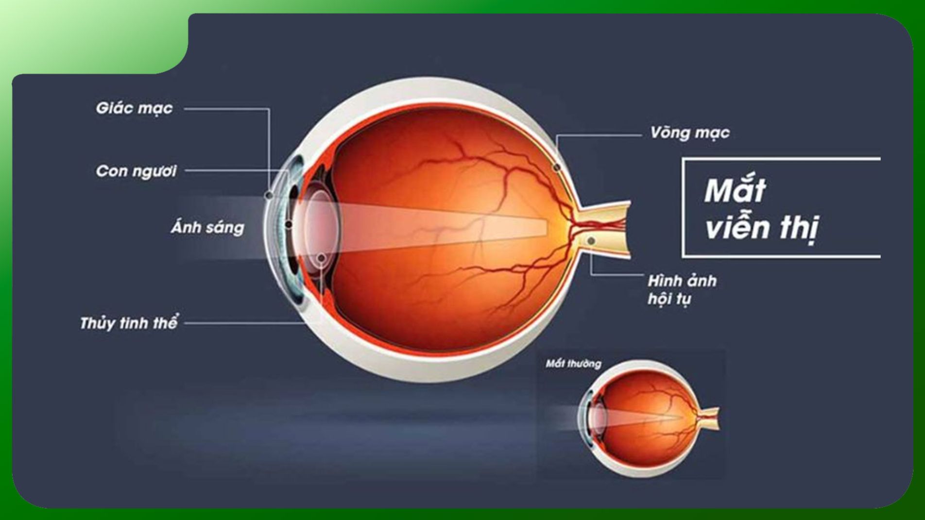 Hình ảnh mắt viễn thị với hướng dẫn điều trị, giúp hiểu rõ hơn về tình trạng. (mathanoi2.vn)