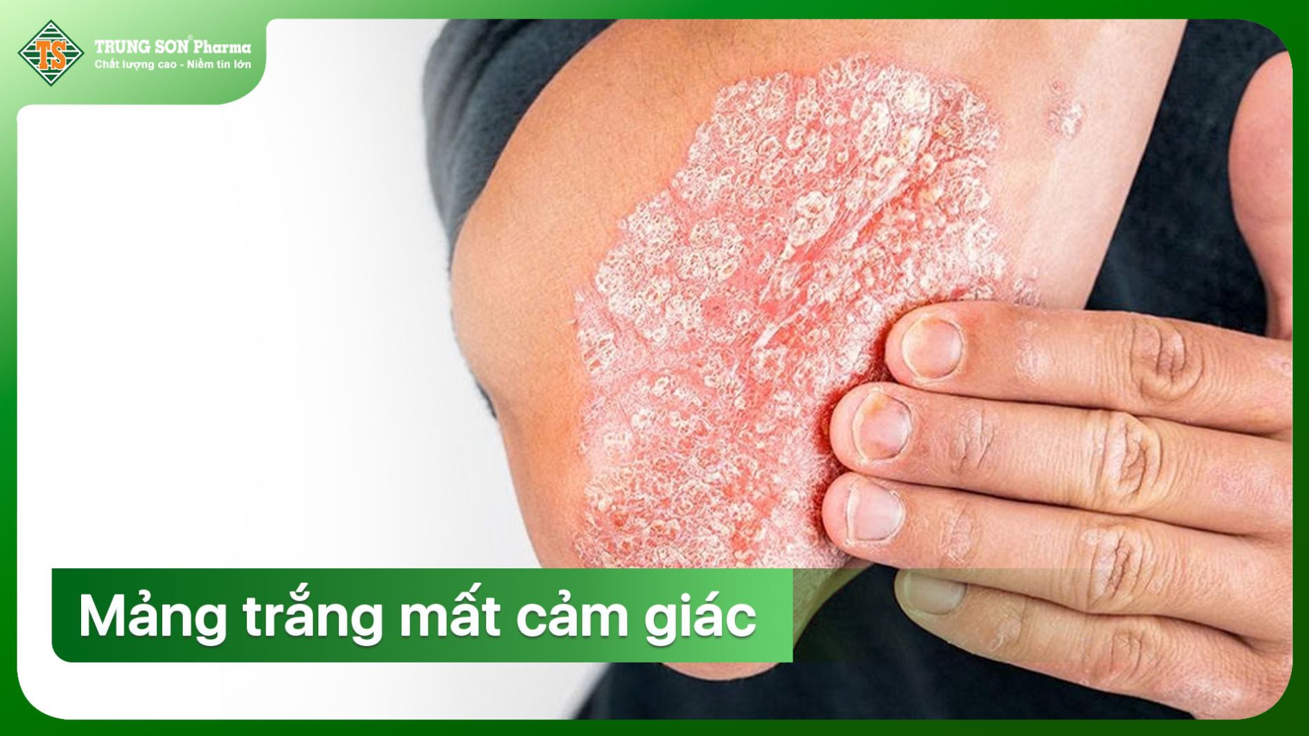 (Tổn thương da điển hình trong bệnh phong – mảng trắng mất cảm giác)