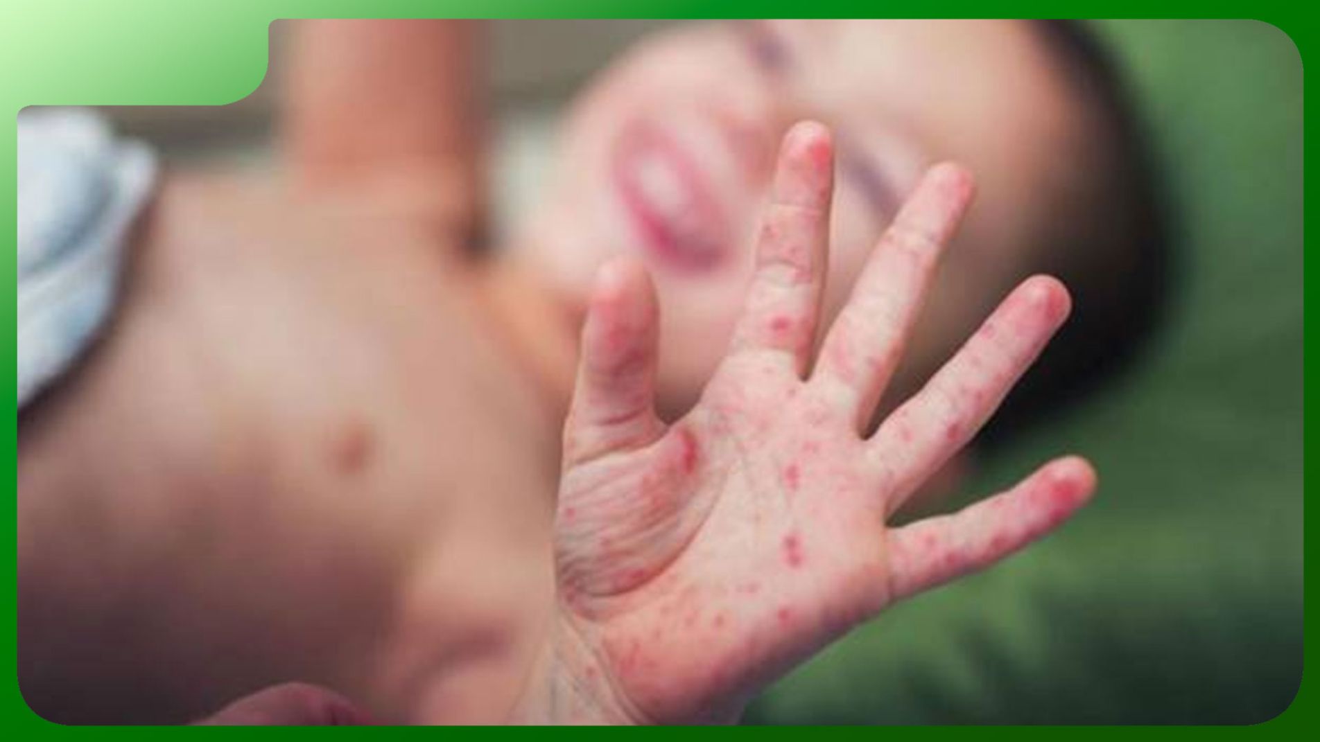 Phát ban điển hình bệnh tay chân miệng – mụn nước đỏ trên lòng bàn tay, bàn chân và loét miệng