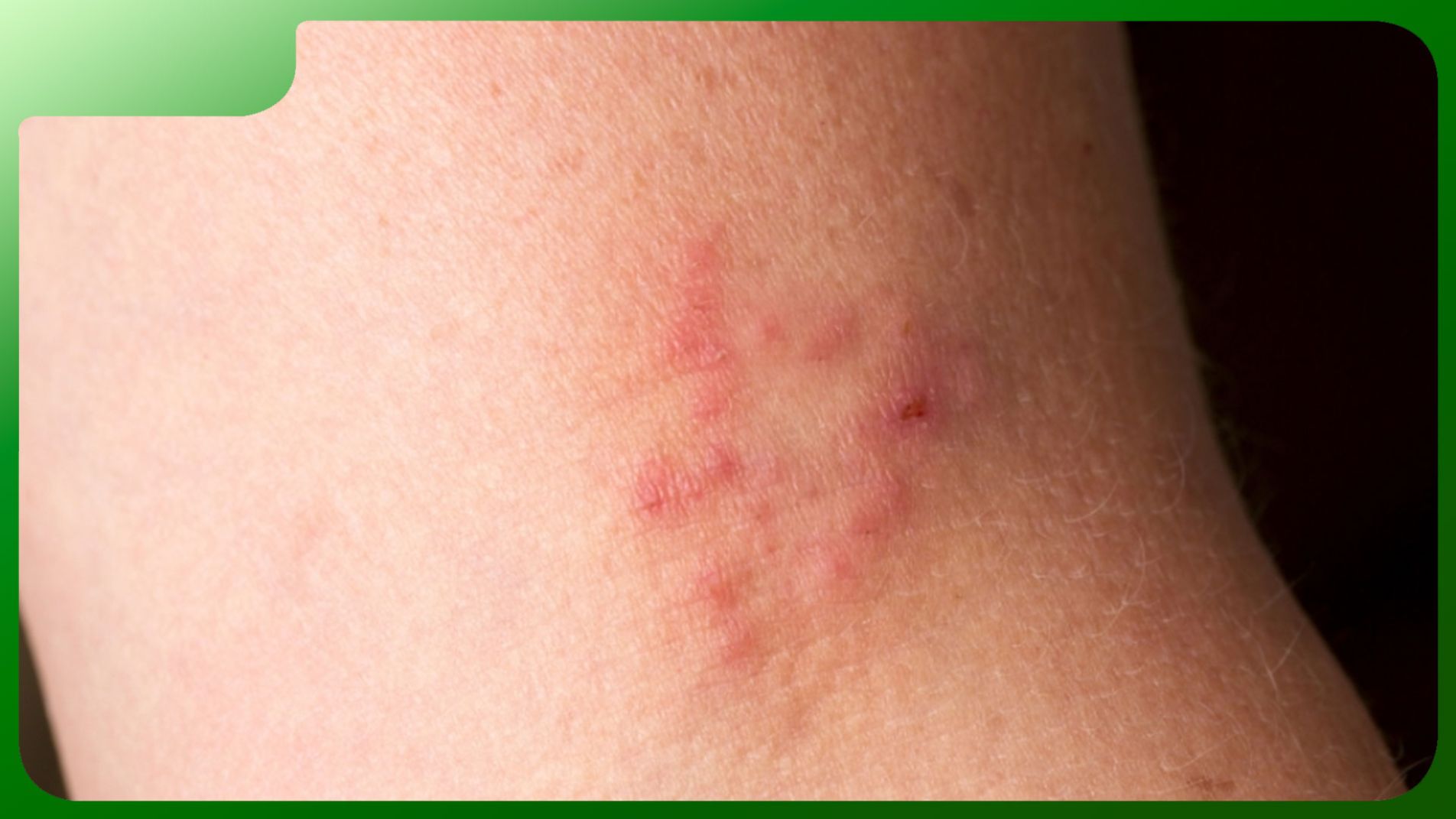 (Hình ảnh săng giang mai ở giai đoạn nguyên phát – vết loét không đau điển hình)