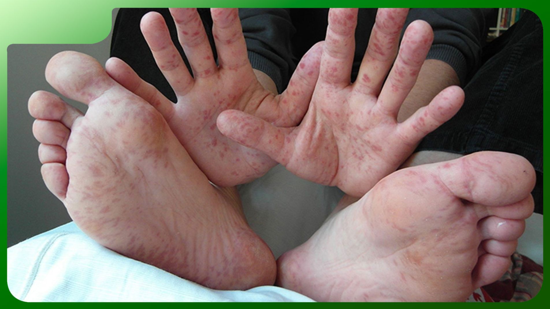 (Phát ban thứ phát đặc trưng trên lòng bàn tay và bàn chân)