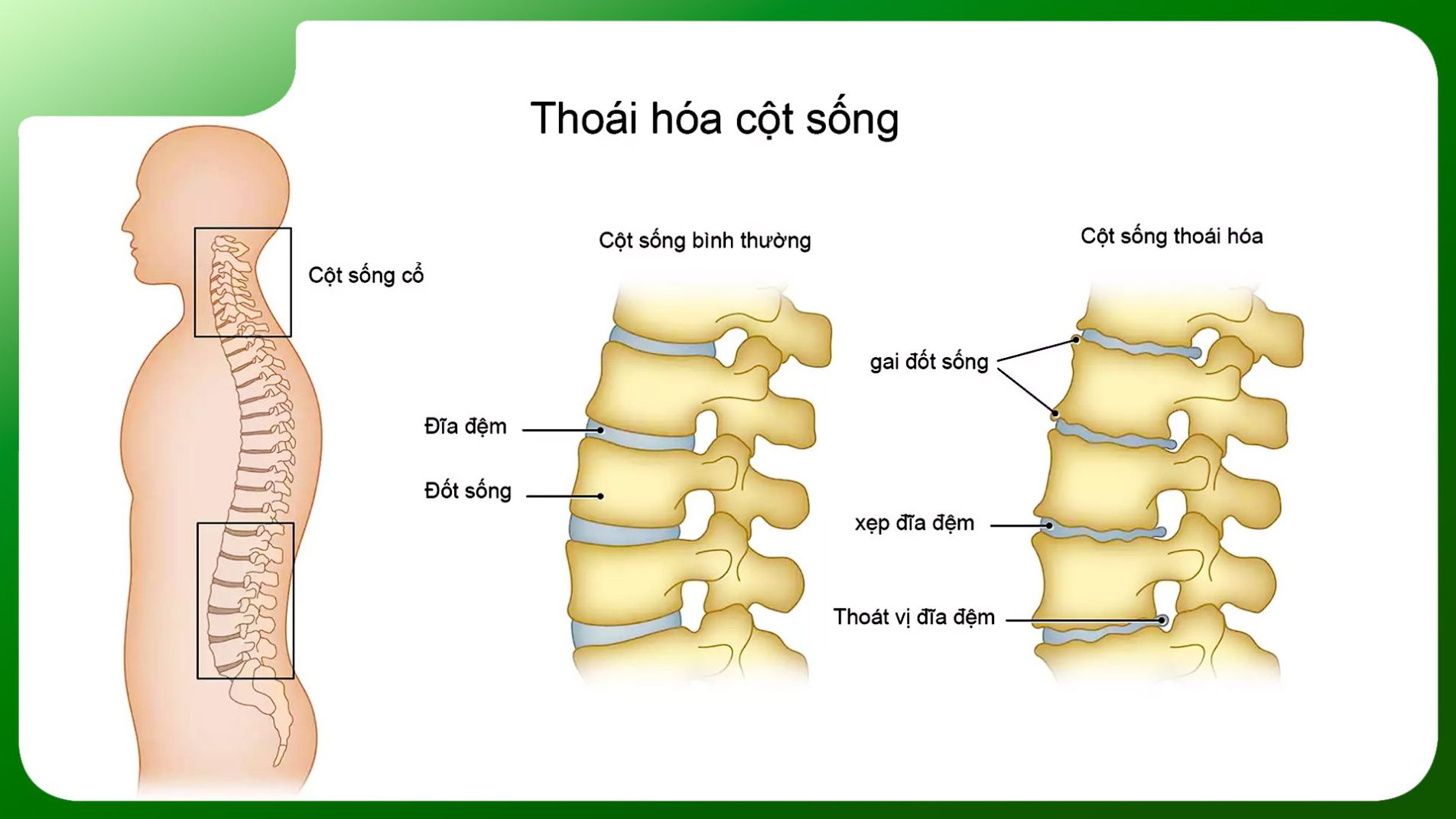 Thoái hóa đốt sống cổ - Hiểu rõ, chữa đúng! 