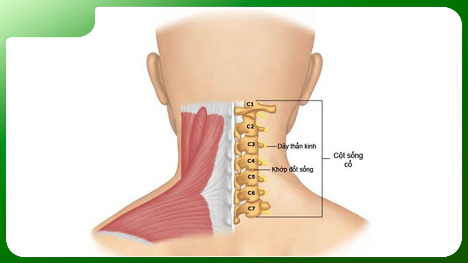 Gai xương và hẹp khe khớp ở thoái hóa đốt sống cổ. 