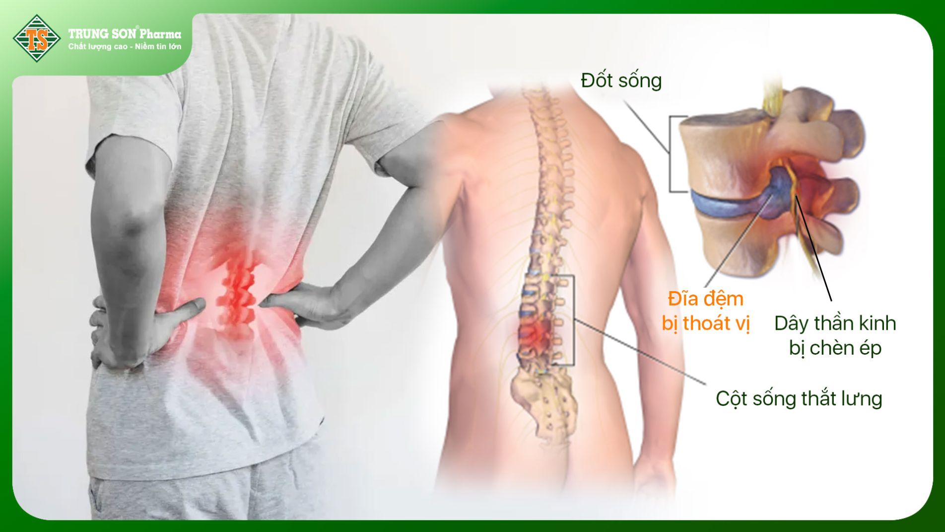 Thoát vị đĩa đệm cột sống thắt lưng L4 L5