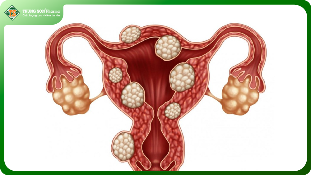 Nhân xơ tử cung: dấu hiệu nhận biết và biến chứng thường gặp