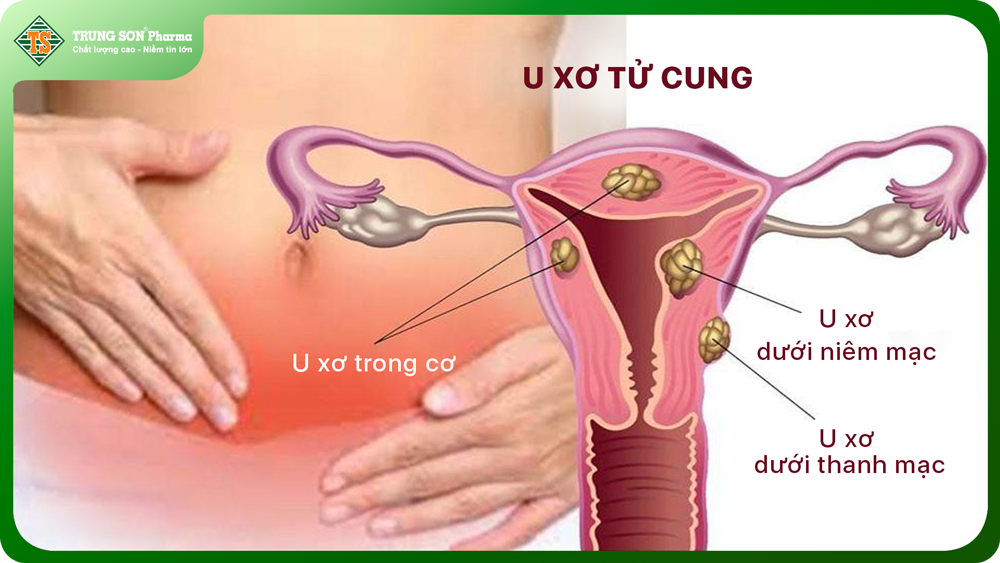 Các dấu hiệu của u xơ tử cung