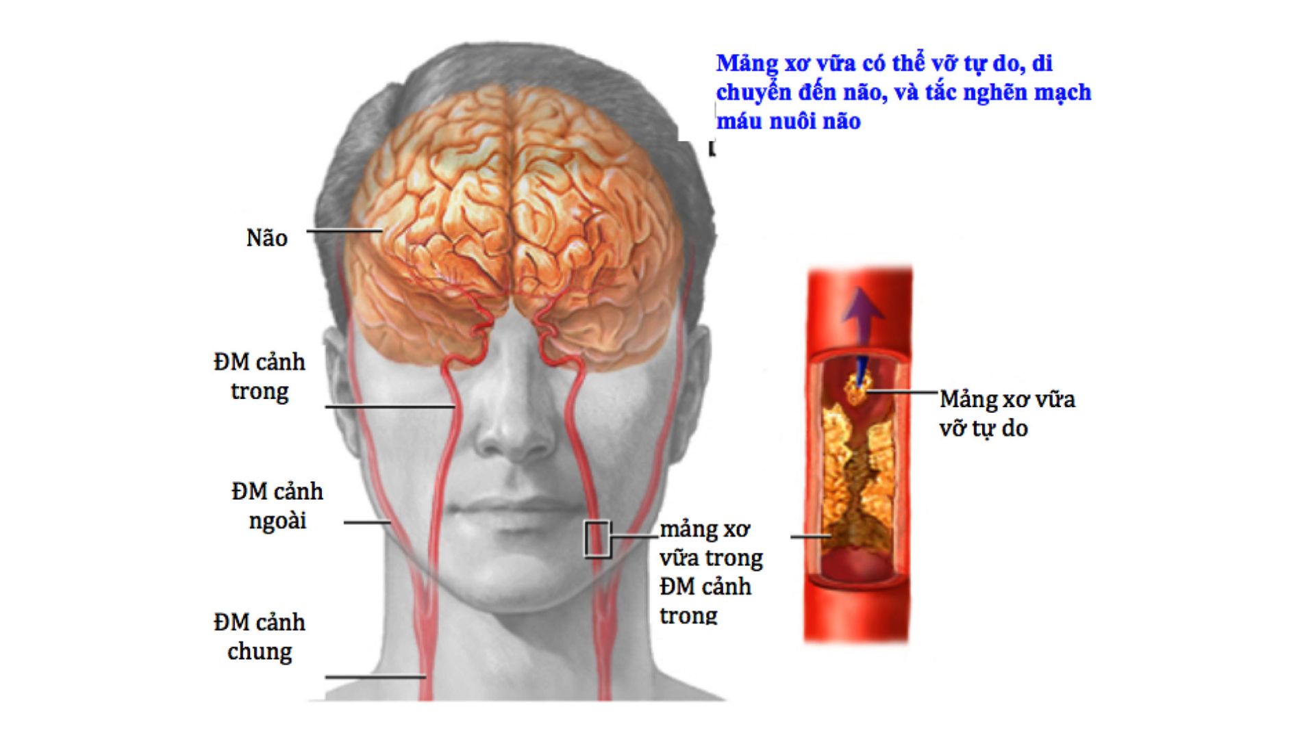 Không chủ quan khi có thiếu máu não cục bộ thoáng qua