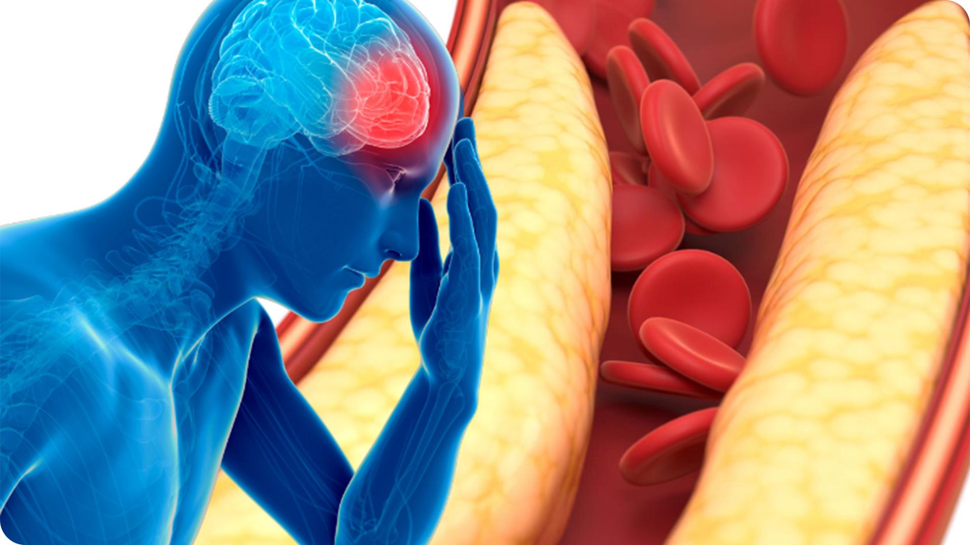 Phòng ngừa cơn thiếu máu não cục bộ thoáng qua