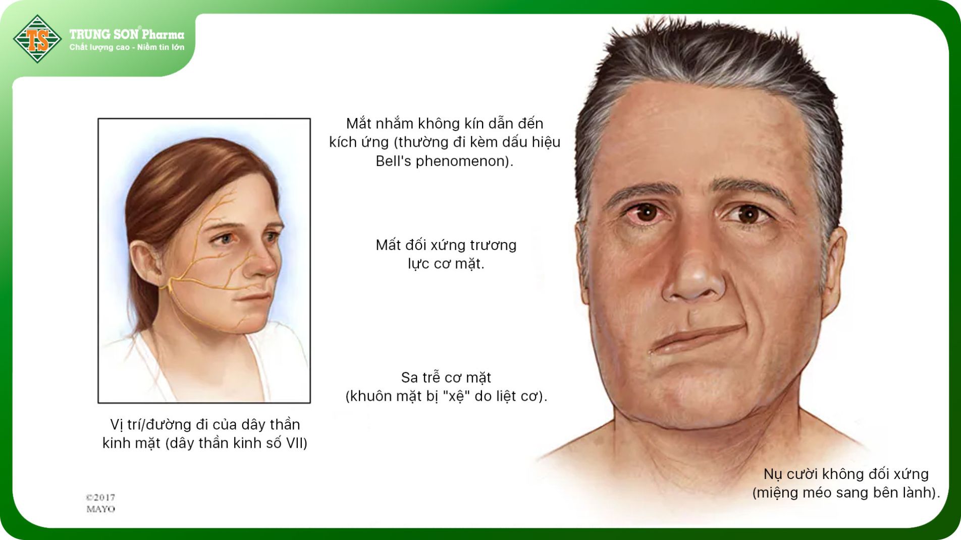 Hình ảnh triệu chứng méo miệng trong liệt dây thần kinh mặt (Bell's palsy)