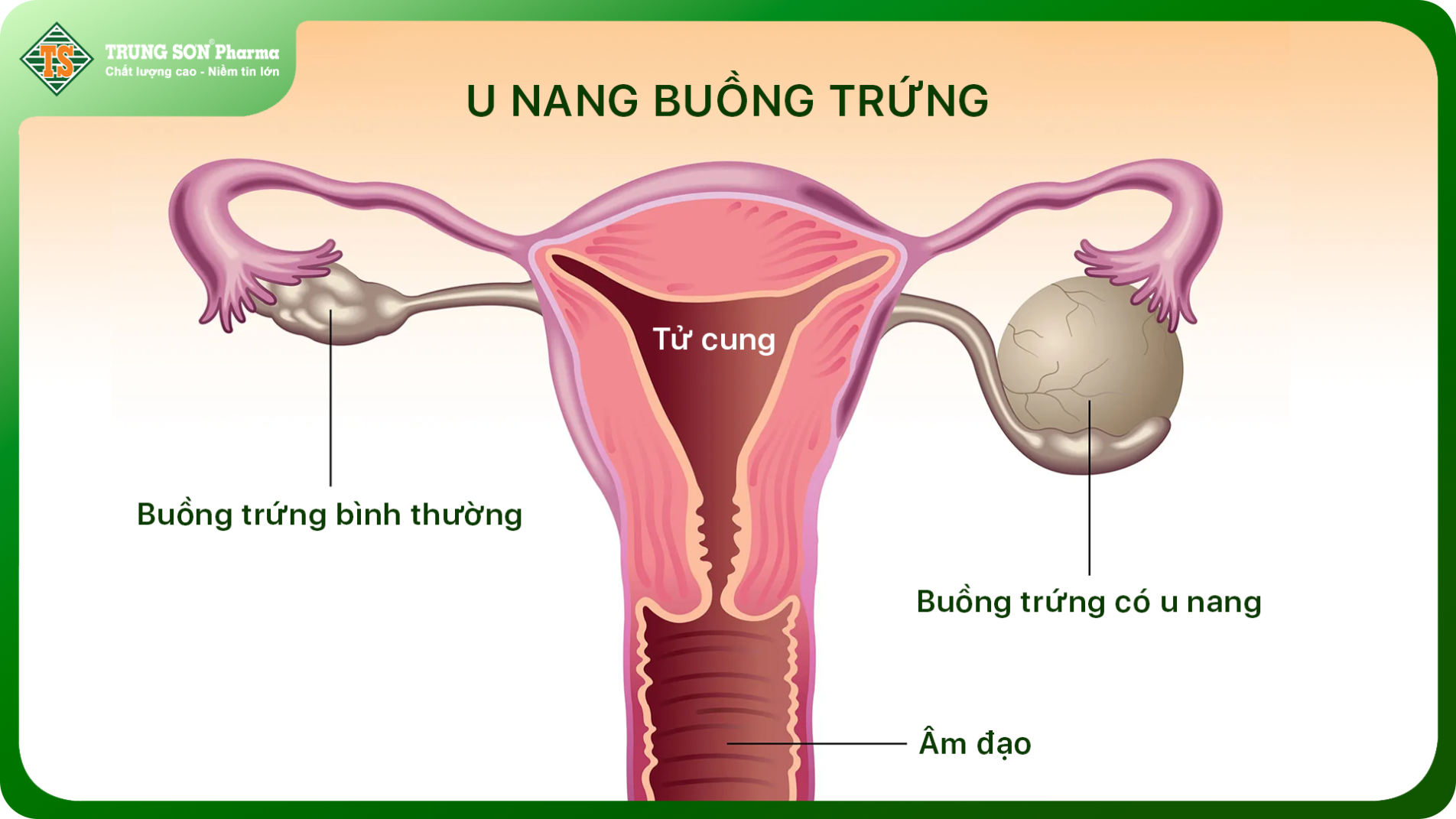 (Cấu trúc buồng trứng bình thường và buồng trứng có u nang)
