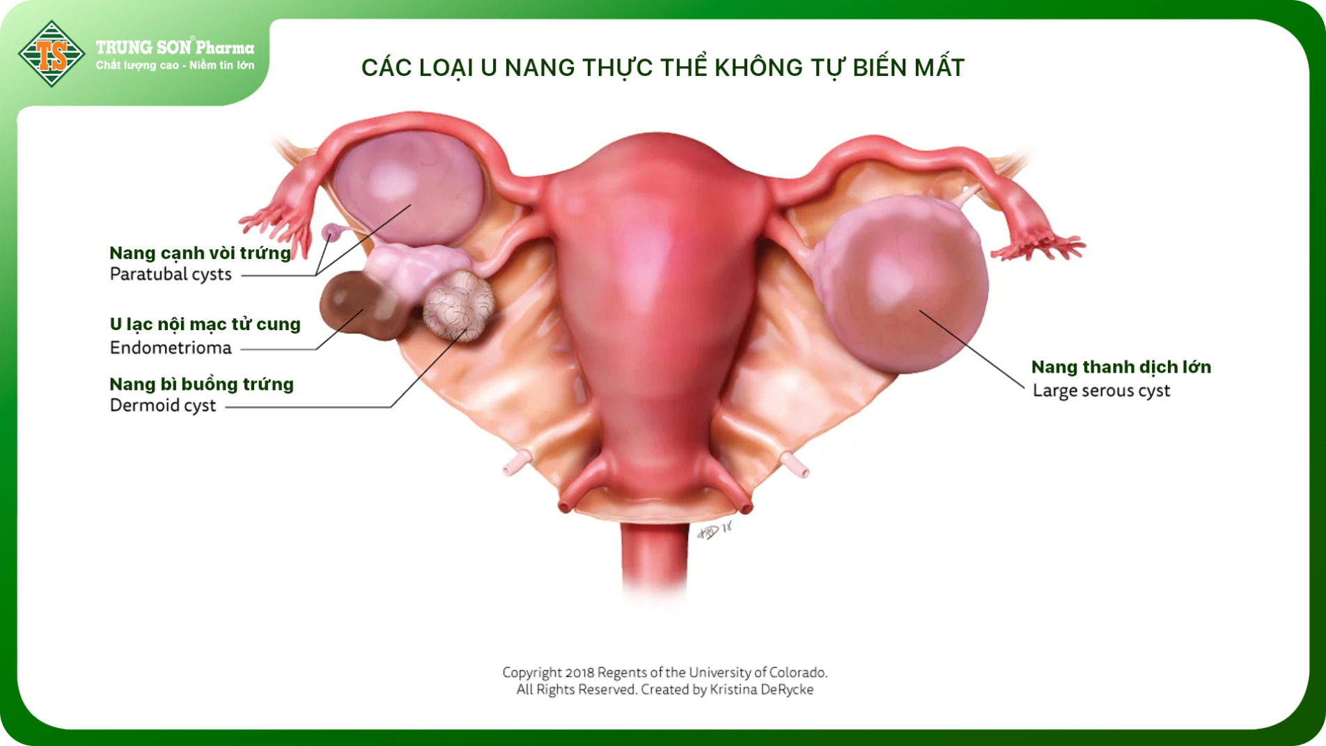 (Minh họa các loại u nang buồng trứng phổ biến và vị trí)