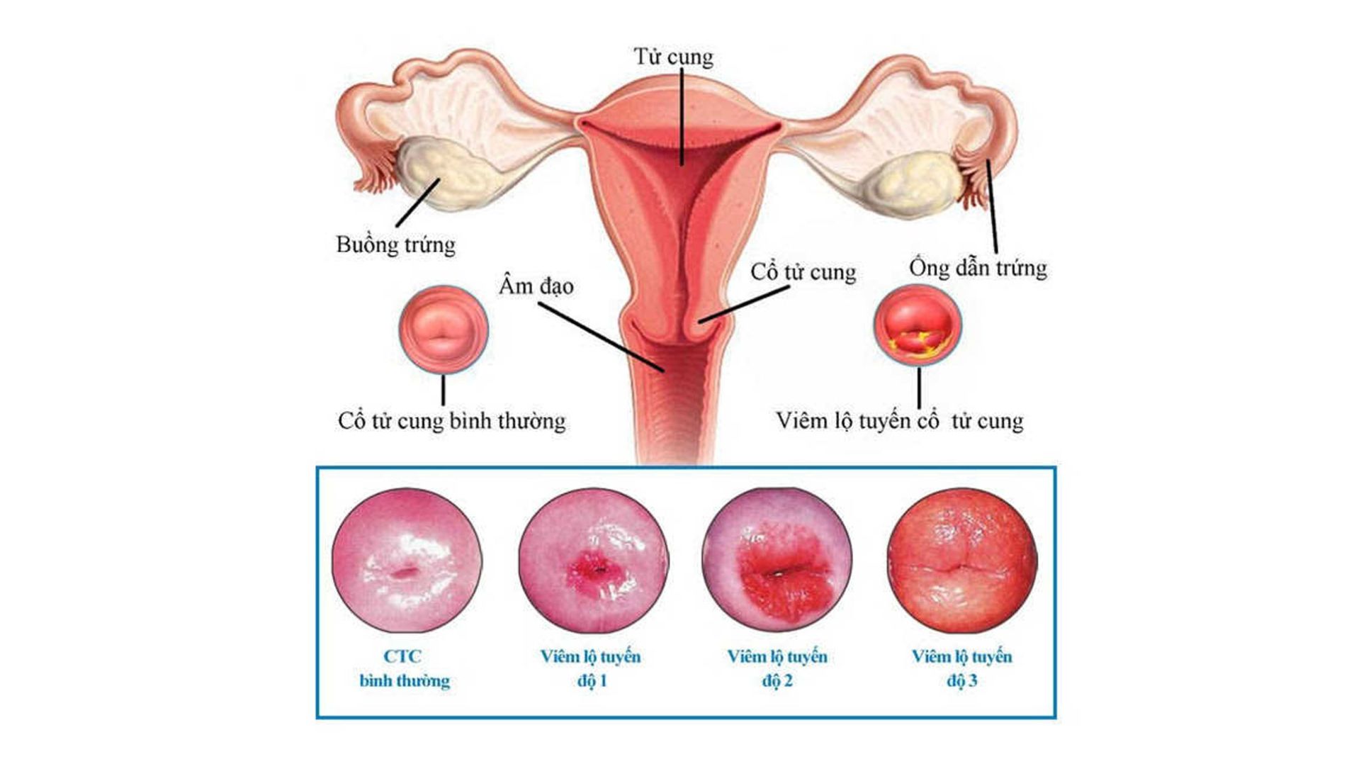 (Cổ tử cung bình thường và tình trạng viêm lộ tuyến ở các cấp độ)