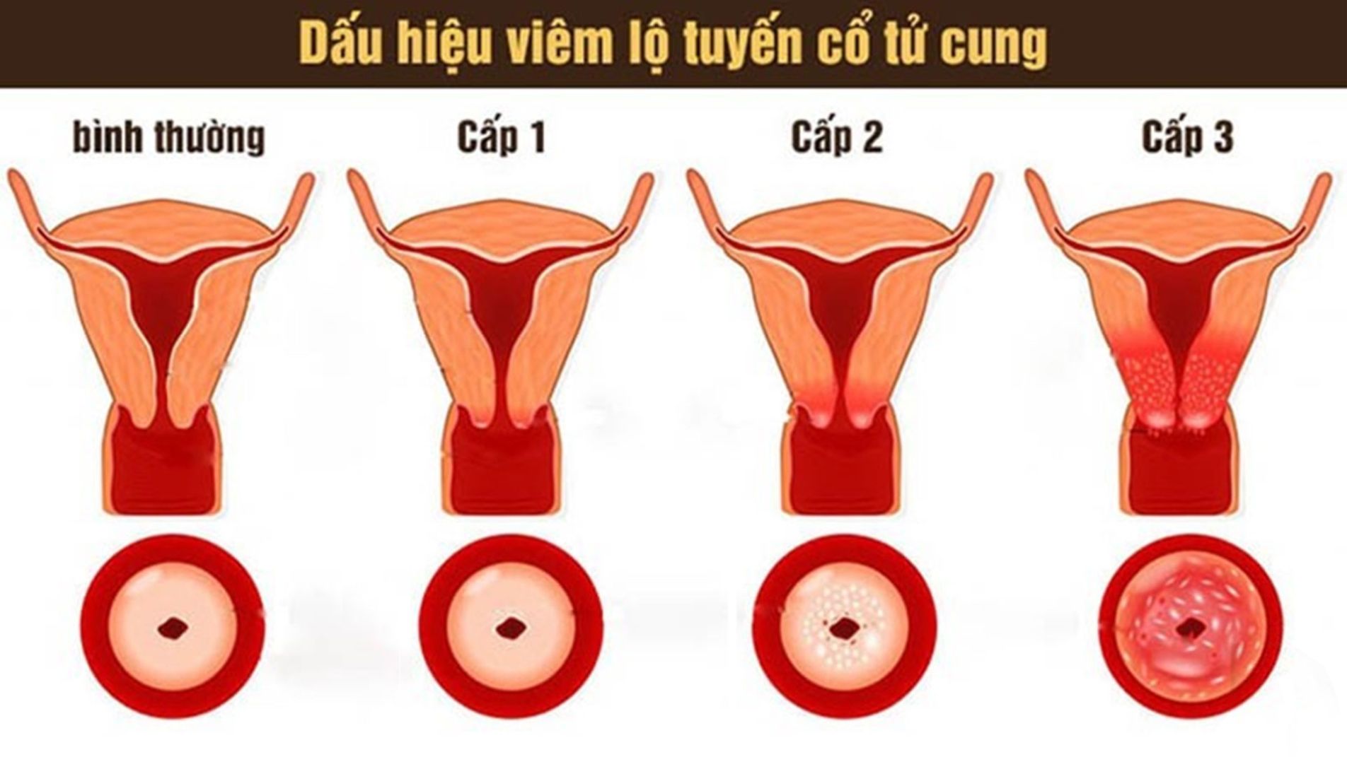 (Các cấp độ viêm lộ tuyến cổ tử cung và cách nhận biết qua hình ảnh)