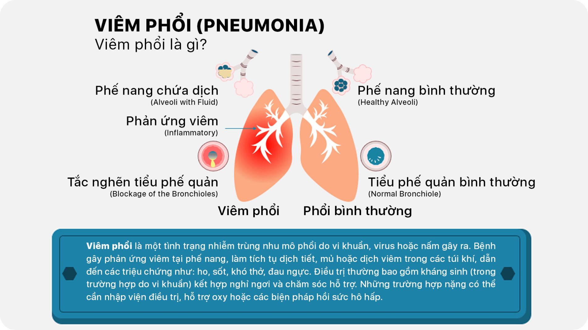 Viêm phổi là tình trạng nhiễm trùng gây viêm các túi khí nhỏ (alveoli) trong phổi.