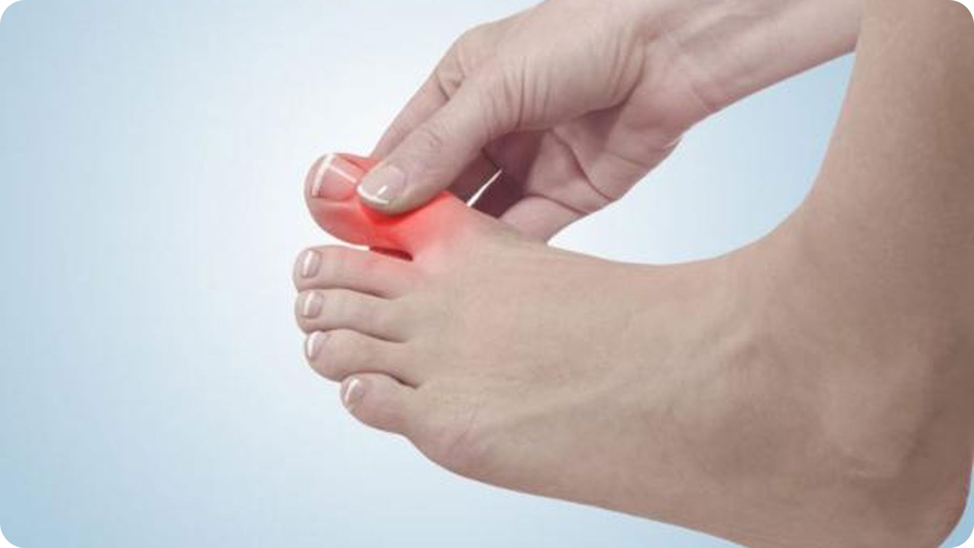 Triệu chứng điển hình của bệnh gút: sưng đỏ ngón chân cái